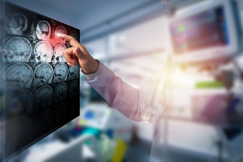 Stroke: minden, amit tudni kell a szélütésről