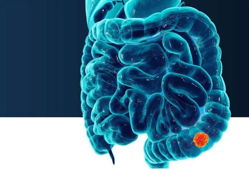 ColonAiQ: genetikai teszt a vastagbél- és végbélrák szűrésére